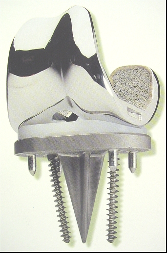 Künstliches Kniegelenk